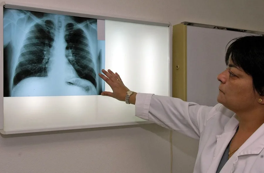 datos sobre la silicosis