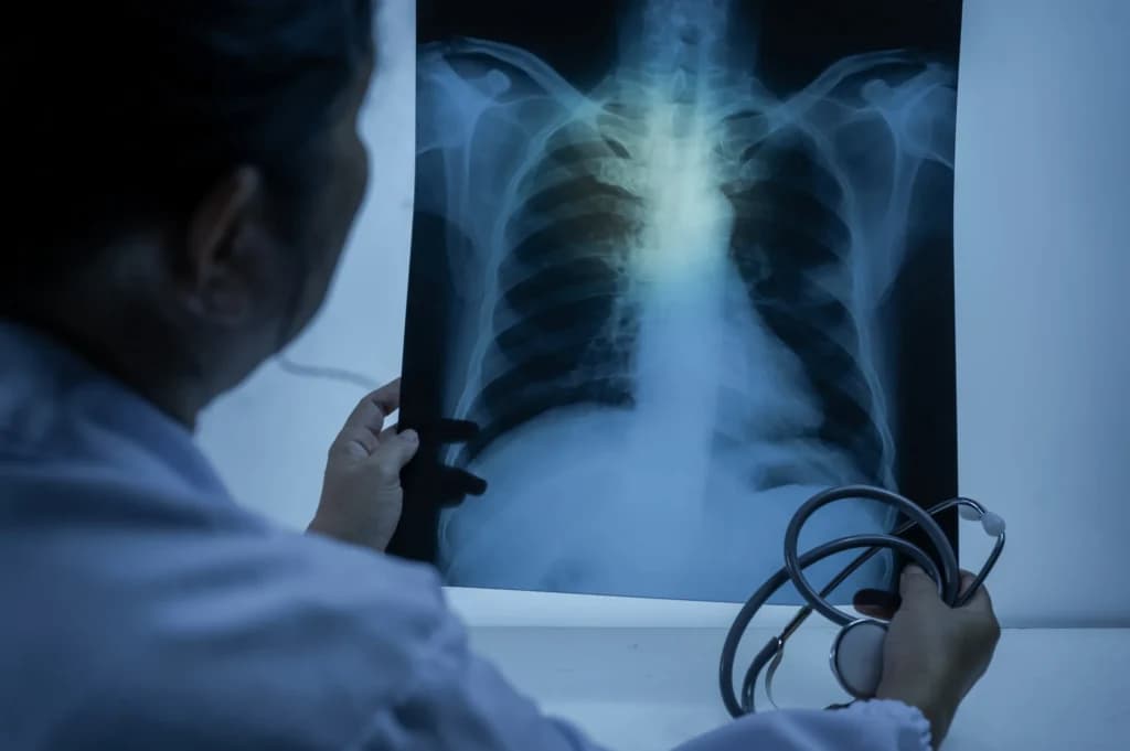 ¿Qué es la peste neumónica y por qué preocupa en EE.UU.?